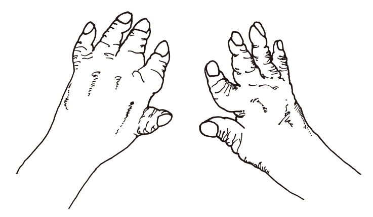 反応性関節炎の症状